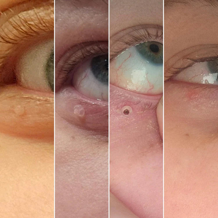 DermaTag – Set zur Entfernung von Hautwarzen