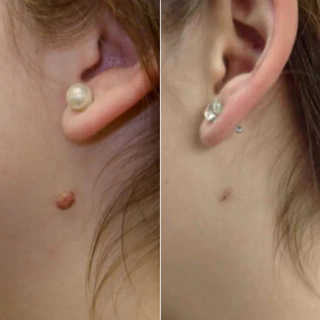 DermaTag – Set zur Entfernung von Hautwarzen