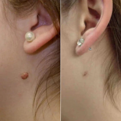 DermaTag – Set zur Entfernung von Hautwarzen